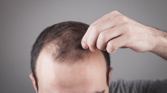 Los 5 mejores productos para la caída del cabello en hombres