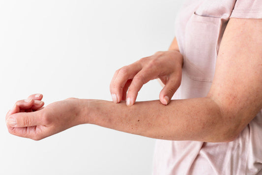 Mujer rascandose por picadura de mosquitos
